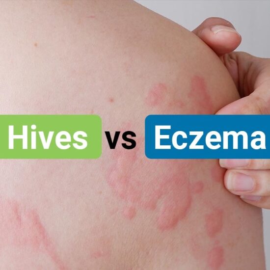 Hives vs Eczema