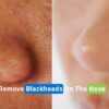 remove blackheads on the nose