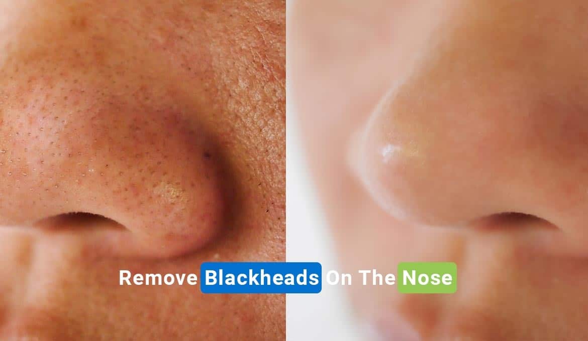 remove blackheads on the nose