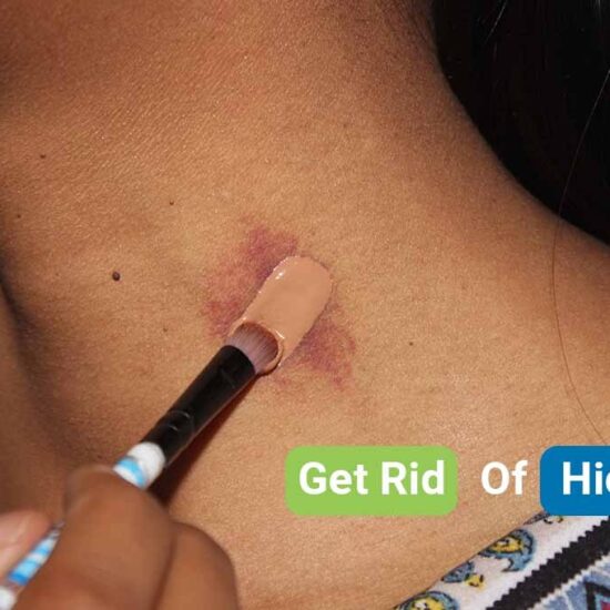 how to get rid of hickeys
