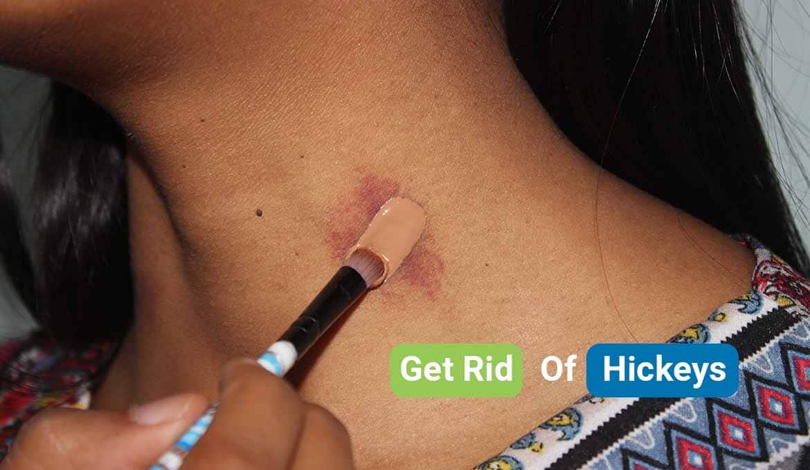 how to get rid of hickeys