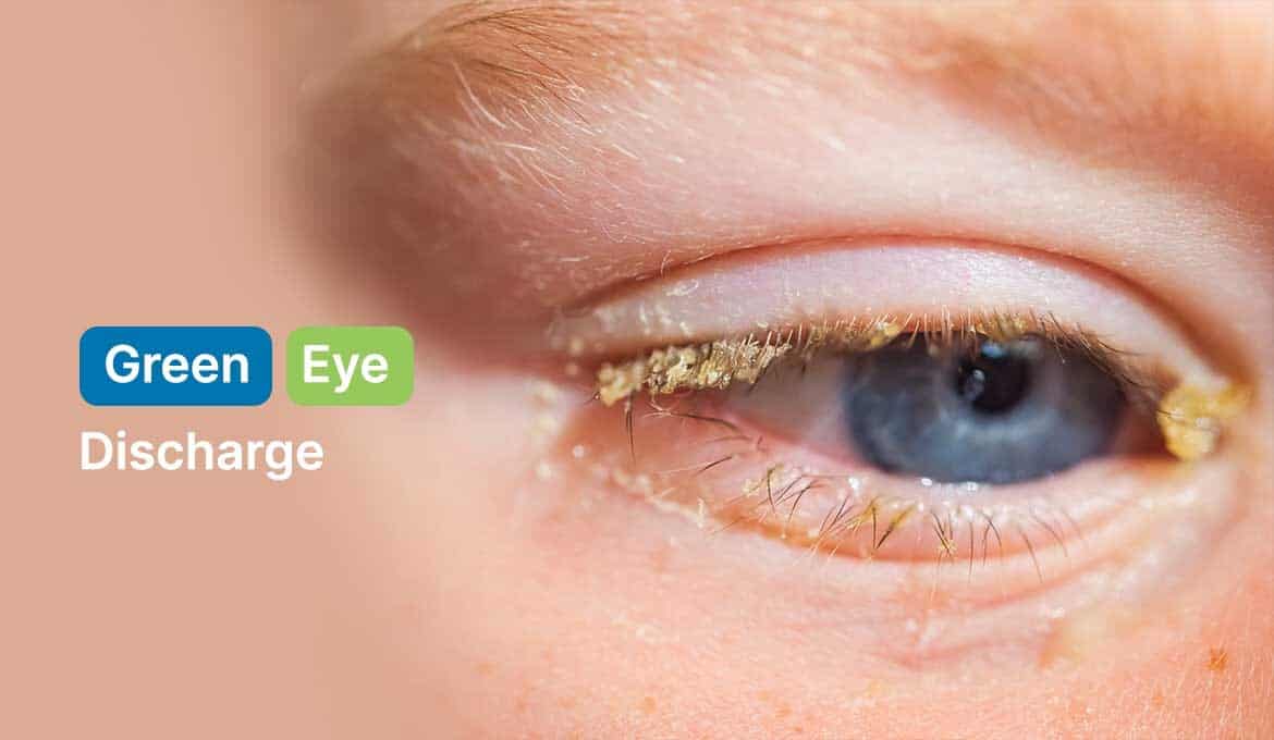 Green Eye Discharge