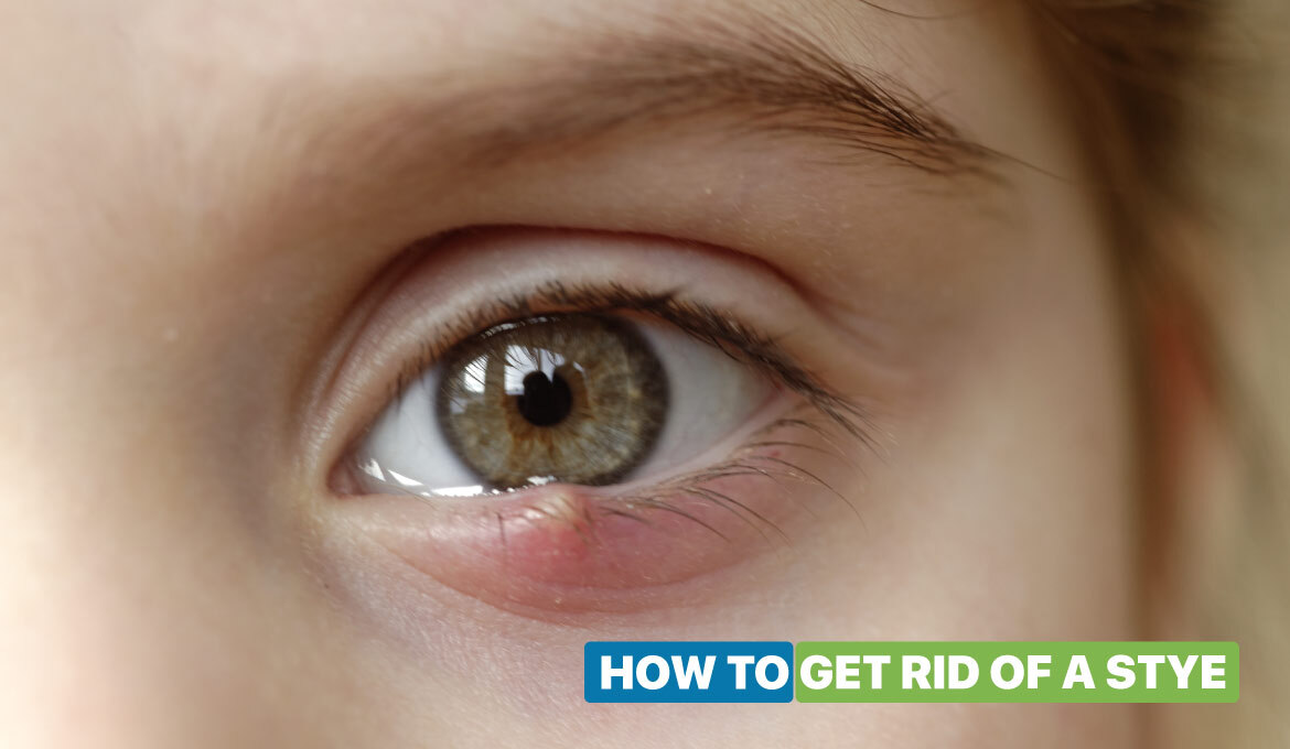 How To Get Rid Of A Stye