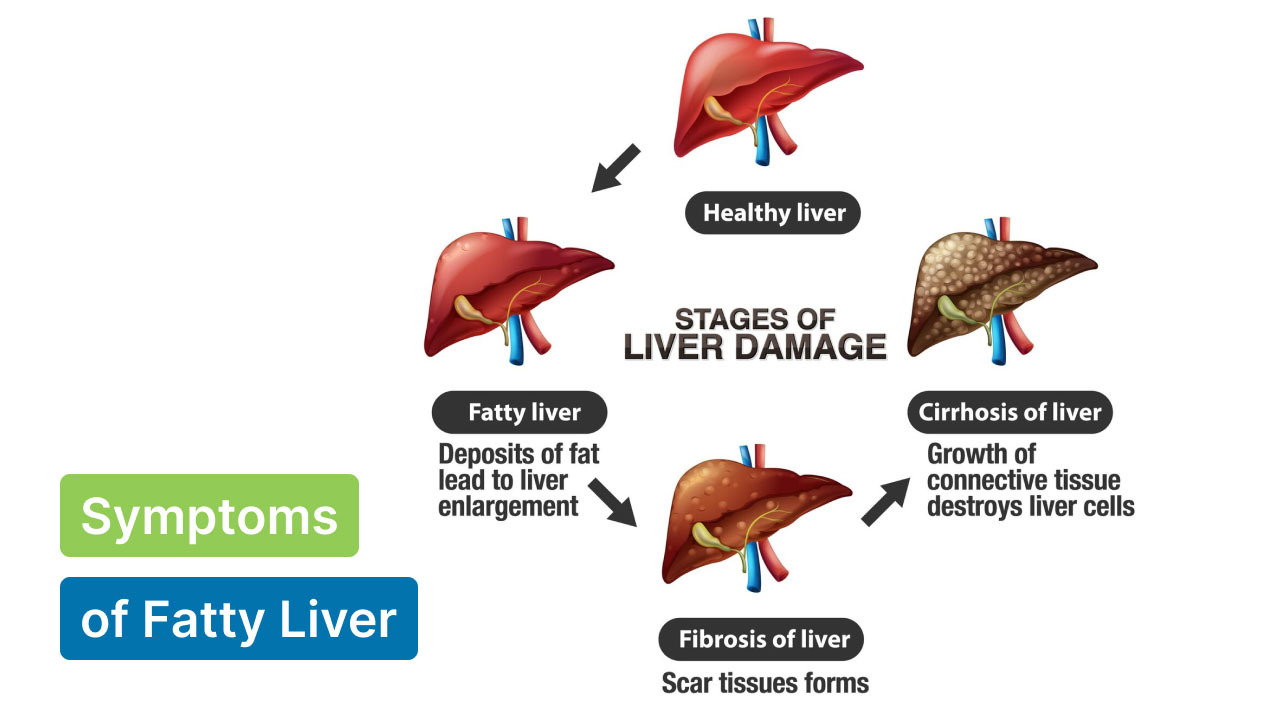 symptoms of fatty liver